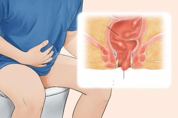 Càng lớn tuổi, nguy cơ xuất hiện polyp càng cao do niêm mạc ruột bị lão hóa và giảm khả năng tự phục hồi tổn thương tế bào.