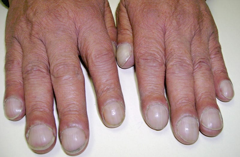 “Ngón tay dùi trống” (hay còn gọi là ngón tay hình dùi trống) là một hiện tượng bất thường ở ngón tay hoặc ngón chân, nơi đầu ngón trở nên to bè ra giống như dùi trống