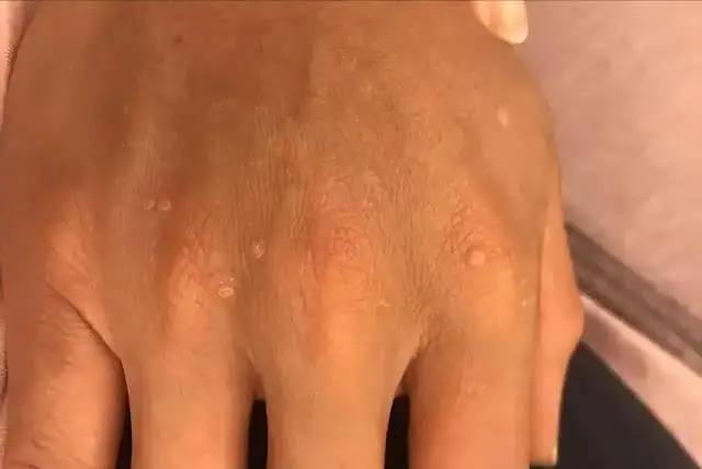 4 thay đổi ở ngón tay có thể là dấu hiệu ung thư phổi, hãy đi khám ngay!- Ảnh 5.