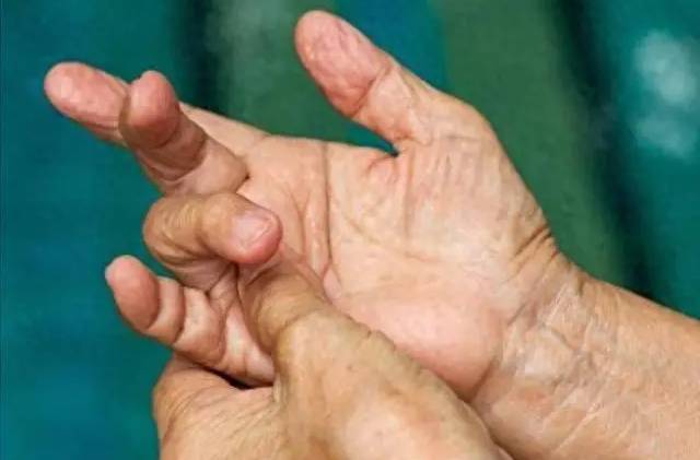 4 thay đổi ở ngón tay có thể là dấu hiệu ung thư phổi, hãy đi khám ngay!- Ảnh 6.