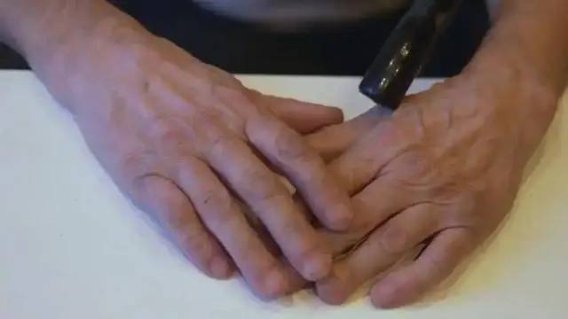 4 thay đổi ở ngón tay có thể là dấu hiệu ung thư phổi, hãy đi khám ngay!- Ảnh 3.