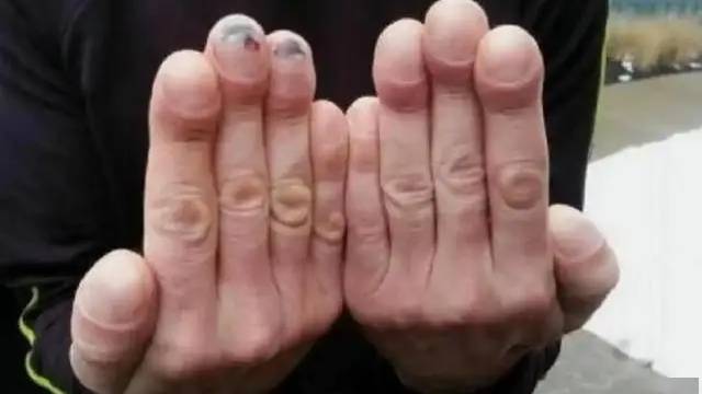 4 thay đổi ở ngón tay có thể là dấu hiệu ung thư phổi, hãy đi khám ngay!- Ảnh 2.