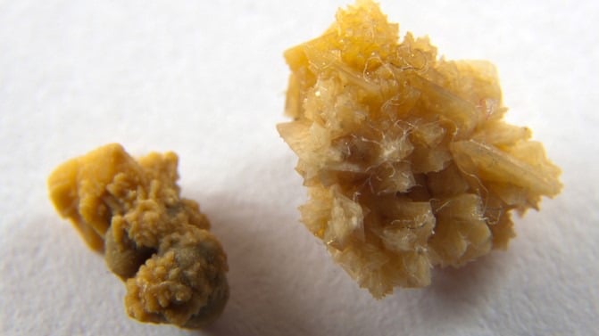 soi_than_hinh_thanh_nhu_the_nao_cac_loai_soi_than_thuong_gap_nhat_cb8a458fb5