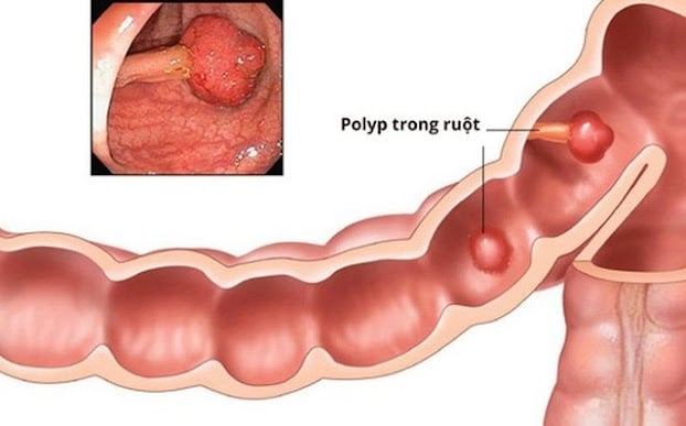Các Polyp trong ruột