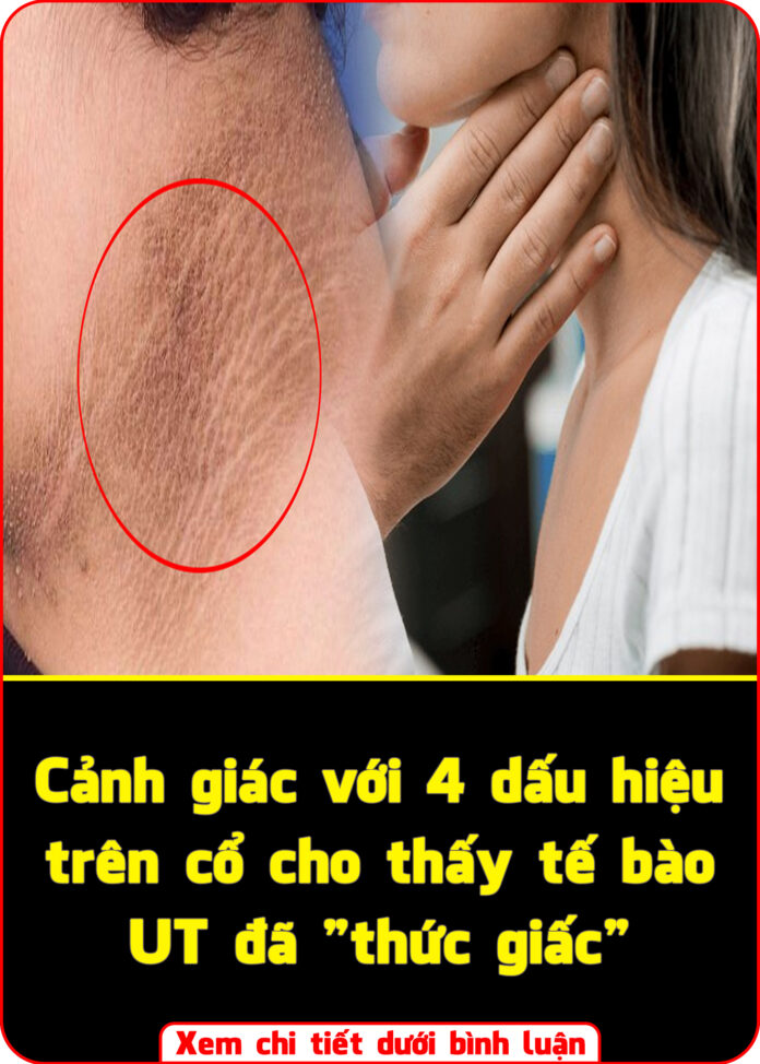 Cảnh giác với 4 dấu hiệu trên cổ cho thấy tế bào UT đã thức giấc