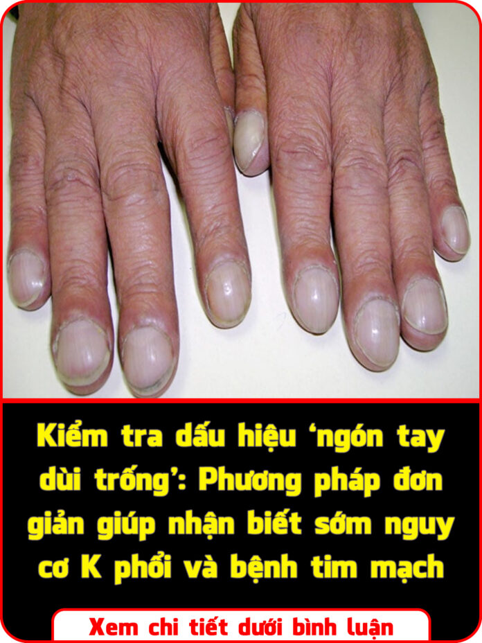 Kiểm tra dấu hiệu ‘ngón tay dùi trống’ Phương pháp đơn giản giúp nhận biết sớm nguy cơ K phổi và bệnh tim mạch