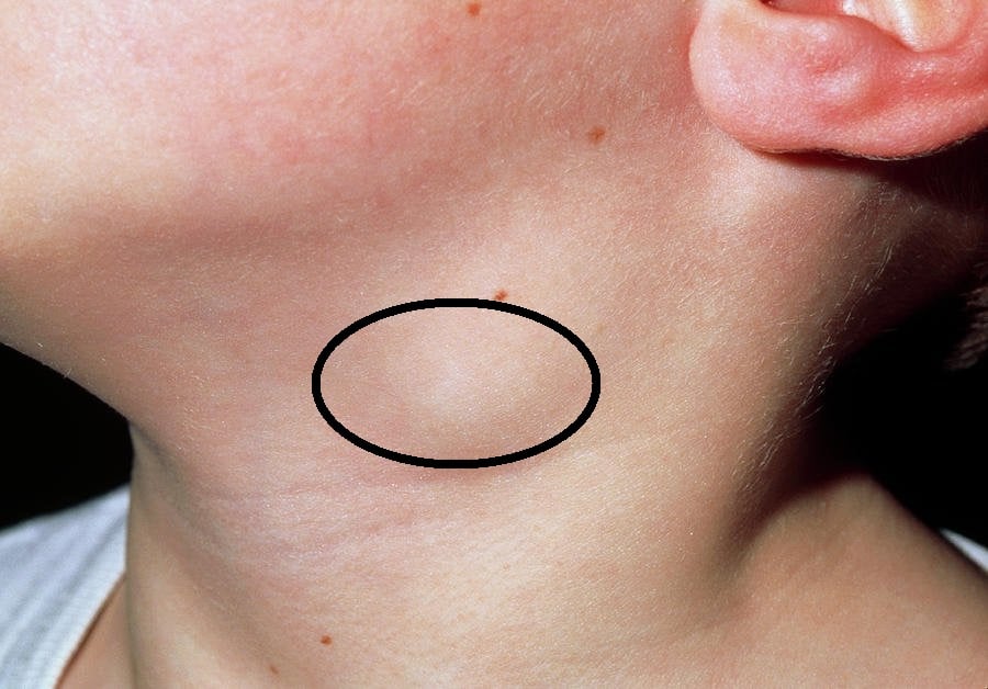 Buổi sáng phát hiện những vết bầm tím không rõ lý do, các nốt cứng dưới da, không đau nhưng ngày càng to, đặc biệt ở ngực, nách, cổ, bụng.